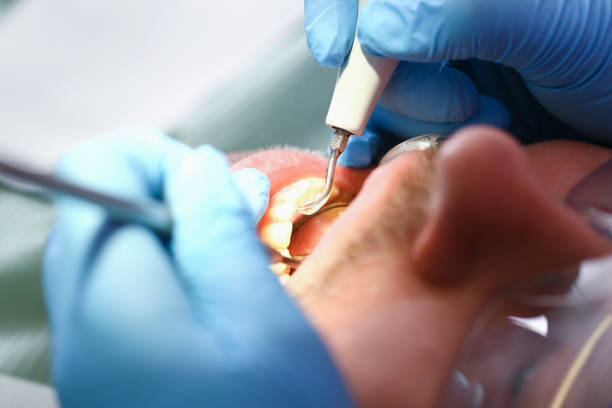 Best Knocked-Out Tooth (Avulsed Tooth) Treatment in Cosmopolis, WA